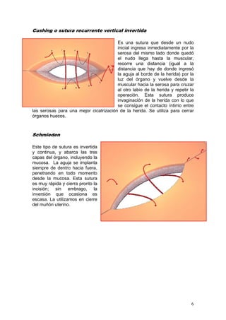 6 
Cushing o sutura recurrente vertical invertida 
Es una sutura que desde un nudo 
inicial ingresa inmediatamente por la 
serosa del mismo lado donde quedó 
el nudo llega hasta la muscular, 
recorre una distancia (igual a la 
distancia que hay de donde ingresó 
la aguja al borde de la herida) por la 
luz del órgano y vuelve desde la 
muscular hacia la serosa para cruzar 
al otro labio de la herida y repetir la 
operación. Esta sutura produce 
invaginación de la herida con lo que 
se consigue el contacto íntimo entre 
las serosas para una mejor cicatrización de la herida. Se utiliza para cerrar 
órganos huecos. 
Schmieden 
Este tipo de sutura es invertida 
y continua, y abarca las tres 
capas del órgano, incluyendo la 
mucosa. La aguja se implanta 
siempre de dentro hacia fuera, 
penetrando en todo momento 
desde la mucosa. Esta sutura 
es muy rápida y cierra pronto la 
incisión; sin embrago, la 
inversión que ocasiona es 
escasa. La utilizamos en cierre 
del muñón uterino. 
 
