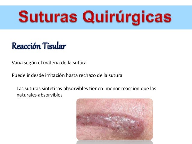 Suturas