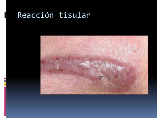 Características Que Definen La Reacción Inflamatoria Por Material De Sutura