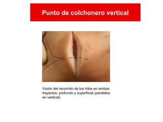 Visión del recorrido de los hilos en ambos
trayectos: profundo y superficial (paralelos
en vertical).
Punto de colchonero vertical
Punto de colchonero vertical
 