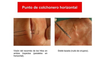 Visión del recorrido de los hilos en
ambos trayectos (paralelos en
horizontal).
Doble lazada (nudo de cirujano).
Punto de colchonero horizontal
Punto de colchonero horizontal
 