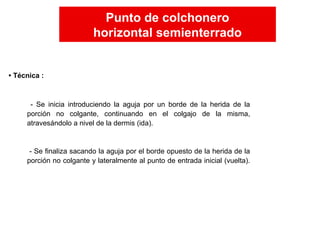- Se inicia introduciendo la aguja por un borde de la herida de la
porción no colgante, continuando en el colgajo de la misma,
atravesándolo a nivel de la dermis (ida).
- Se finaliza sacando la aguja por el borde opuesto de la herida de la
porción no colgante y lateralmente al punto de entrada inicial (vuelta).
• Técnica :
Punto de colchonero
horizontal semienterrado
Punto de colchonero
horizontal semienterrado
 