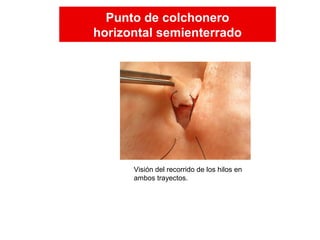 Visión del recorrido de los hilos en
ambos trayectos.
Punto de colchonero
horizontal semienterrado
Punto de colchonero
horizontal semienterrado
 