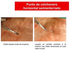 Lazada en sentido contrario a la
anterior tras haber tensionado el nudo
sobre la piel.
Doble lazada (nudo de cirujano).
Punto de colchonero
horizontal semienterrado
Punto de colchonero
horizontal semienterrado
 
