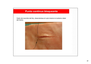 17
Visión del recorrido del hilo, observándose el nudo inicial en el extremo distal
del mismo.
Punto continuo bloqueante
 