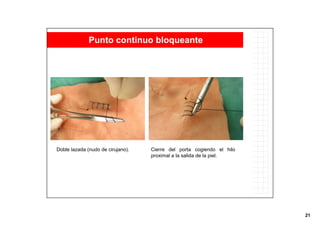 21
Doble lazada (nudo de cirujano). Cierre del porta cogiendo el hilo
proximal a la salida de la piel.
Punto continuo bloqueante
 