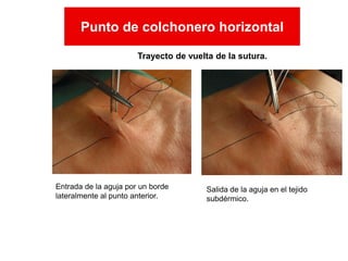Entrada de la aguja por un borde
lateralmente al punto anterior.
Salida de la aguja en el tejido
subdérmico.
Punto de colchonero horizontal
T Trayecto de vuelta de la sutura.
Punto de colchonero horizontal
 