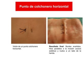 Visión de un punto colchonero
horizontal.
Resultado final: Bordes evertidos,
hilos paralelos a la incisión (sutura
estética) y nudos a un lado de la
herida.
Punto de colchonero horizontal
Punto de colchonero horizontal
 