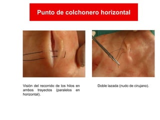 Visión del recorrido de los hilos en
ambos trayectos (paralelos en
horizontal).
Doble lazada (nudo de cirujano).
Punto de colchonero horizontal
Punto de colchonero horizontal
 
