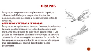 GRAPAS
Las grapas no penetran completamente la piel, a
diferencia del hilo, por lo que disminuyen las
posibilidades de infección y de isquemizar el tejido
suturado.
Aplicación y retirada de grapas
Las grapas se aplican con la mano dominante, mientras
la mano no dominante evierte los bordes de la piel
mediante unas pinzas de disección con dientes (. Las
grapas se mantienen el mismo tiempo que una sutura
convencional en esa región anatómica. La retirada de
las grapas se realiza mediante un extractor de grapas
que proporciona el mismo distribuidor de las
grapadoras
 