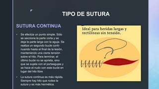 z
TIPO DE SUTURA
SUTURA CONTINUA
 Se efectúa un punto simple. Sólo
se secciona la parte corta y se
deja la parte larga con la aguja. Se
realiza un segundo bucle conti-
nuando hasta el final de la lesión,
manteniendo una cierta tensión
sobre el hilo. Para terminar, el
último bucle no se aprieta, sino
que se sujeta con el portaagujas y
se hace el nudo con este bucle en
lugar del hilo libre
 La sutura continua es más rápida.
Siempre hay hilo que rodea la
sutura y es más hermética.
 