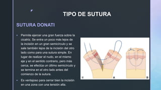 z
TIPO DE SUTURA
SUTURA DONATI
 Permite ejercer una gran fuerza sobre la
cicatriz. Se entra un poco más lejos de
la incisión en un gran semicírculo y se
sale también lejos de la incisión del otro
lado como para una sutura simple. En
lugar de realizar el nudo, en el mismo
eje y en el sentido contrario, pero más
cerca, se efectúa un último semicírculo y
se termina en el otro lado antes del
comienzo de la sutura.
 Es ventajoso para cerrar bien la incisión
en una zona con una tensión alta.
 