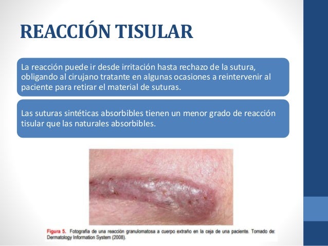 Suturas quirúrgicas