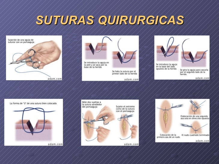 SUTURA