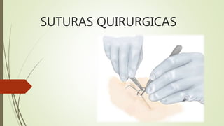 SUTURAS QUIRURGICAS
 