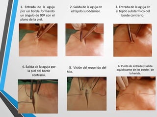1. Entrada de la aguja
por un borde formando
un ángulo de 90º con el
plano de la piel.
2. Salida de la aguja en
el tejido subdérmico.
3. Entrada de la aguja en
el tejido subdérmico del
borde contrario.
4. Salida de la aguja por
la piel del borde
contrario.
5. Visión del recorrido del
hilo.
6. Punto de entrada y salida
equidistante de los bordes de
la herida.
 