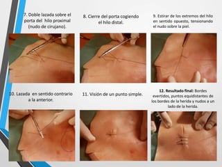 7. Doble lazada sobre el
porta del hilo proximal
(nudo de cirujano).
8. Cierre del porta cogiendo
el hilo distal.
9. Estirar de los extremos del hilo
en sentido opuesto, tensionando
el nudo sobre la piel.
10. Lazada en sentido contrario
a la anterior.
11. Visión de un punto simple.
12. Resultado final: Bordes
evertidos, puntos equidistantes de
los bordes de la herida y nudos a un
lado de la herida.
 