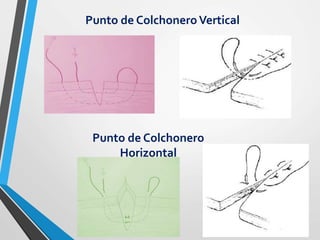 Punto de ColchoneroVertical
Punto de Colchonero
Horizontal
 