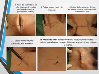 8. Visión del recorrido de los
hilos en ambos trayectos:
profundo y superficial
(paralelos en vertical).
9. Doble lazada (nudo de
cirujano).
10. Estirar de los extremos del hilo
en sentido opuesto, tensionando el
nudo sobre la piel.
11. Lazada en sentido
contrario a la anterior.
12. Resultado final: Bordes evertidos, hilos perpendiculares a la
incisión, con el doble trayecto (lejos-cerca) y nudos a un lado de
la misma.
 