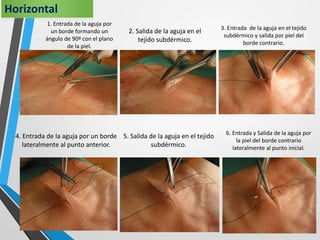 1. Entrada de la aguja por
un borde formando un
ángulo de 90º con el plano
de la piel.
2. Salida de la aguja en el
tejido subdérmico.
3. Entrada de la aguja en el tejido
subdérmico y salida por piel del
borde contrario.
Horizontal
4. Entrada de la aguja por un borde
lateralmente al punto anterior.
5. Salida de la aguja en el tejido
subdérmico.
6. Entrada y Salida de la aguja por
la piel del borde contrario
lateralmente al punto inicial.
 