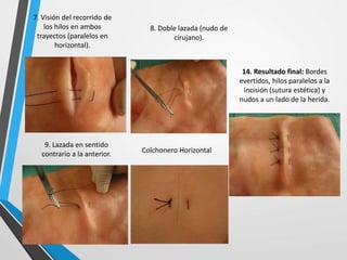 14. Resultado final: Bordes
evertidos, hilos paralelos a la
incisión (sutura estética) y
nudos a un lado de la herida.
9. Lazada en sentido
contrario a la anterior.
8. Doble lazada (nudo de
cirujano).
7. Visión del recorrido de
los hilos en ambos
trayectos (paralelos en
horizontal).
Colchonero Horizontal
 