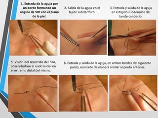 1. Entrada de la aguja por
un borde formando un
ángulo de 90º con el plano
de la piel.
2. Salida de la aguja en el
tejido subdérmico.
3. Entrada y salida de la aguja
en el tejido subdérmico del
borde contrario.
5. Visión del recorrido del hilo,
observándose el nudo inicial en
el extremo distal del mismo.
6. Entrada y salida de la aguja, en ambos bordes del siguiente
punto, realizado de manera similar al punto anterior.
 