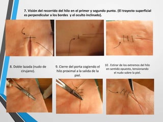 7. Visión del recorrido del hilo en el primer y segundo punto. (El trayecto superficial
es perpendicular a los bordes y el oculto inclinado).
9. Cierre del porta cogiendo el
hilo proximal a la salida de la
piel.
10 . Estirar de los extremos del hilo
en sentido opuesto, tensionando
el nudo sobre la piel.
8. Doble lazada (nudo de
cirujano).
 