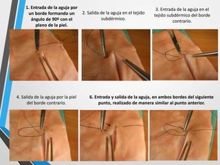 1. Entrada de la aguja por
un borde formando un
ángulo de 90º con el
plano de la piel.
2. Salida de la aguja en el tejido
subdérmico.
3. Entrada de la aguja en el
tejido subdérmico del borde
contrario.
4. Salida de la aguja por la piel
del borde contrario.
6. Entrada y salida de la aguja, en ambos bordes del siguiente
punto, realizado de manera similar al punto anterior.
 