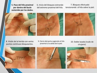 5. Paso del hilo proximal
por dentro del bucle
sostenido por los dedos.
6. Inicio del bloqueo estirando
del extremo proximal del hilo.
7. Bloqueo efectuado
tensionando el hilo sobre la piel.
8. Visión de la herida con varios
puntos continuos bloqueantes.
10. Doble lazada (nudo de
cirujano).
9. Cierre del porta cogiendo el hilo
proximal a la salida de la piel.
 