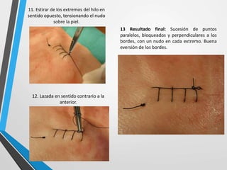 11. Estirar de los extremos del hilo en
sentido opuesto, tensionando el nudo
sobre la piel.
12. Lazada en sentido contrario a la
anterior.
13 Resultado final: Sucesión de puntos
paralelos, bloqueados y perpendiculares a los
bordes, con un nudo en cada extremo. Buena
eversión de los bordes.
 