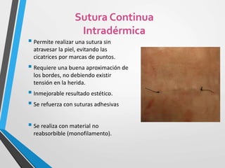  Permite realizar una sutura sin
atravesar la piel, evitando las
cicatrices por marcas de puntos.
 Requiere una buena aproximación de
los bordes, no debiendo existir
tensión en la herida.
 Inmejorable resultado estético.
 Se refuerza con suturas adhesivas
 Se realiza con material no
reabsorbible (monofilamento).
Sutura Continua
Intradérmica
 