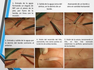1. Entrada de la aguja
formando un ángulo de
90º con el plano de la
piel, por fuera de la
herida, en línea con la
incisión.
2. Salida de la aguja cerca del
vértice, en la dermis de un
borde.
Avanzando de un borde a
otro en sentido horizontal:
3. Entrada y salida de la aguja por
la dermis del borde contrario al
anterior.
4. Visión del recorrido del hilo,
avanzando, tras varios puntos en
la dermis de ambos bordes.
5. Visión de la sutura, tensionando el
hilo, en fase más avanzada
(obsérvese la perfecta aproximación
de los bordes).
 