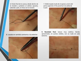 6. Punto final de la sutura, desde dentro de
la incisión y próximo al vértice opuesto,
saliendo a piel, en línea con la incisión.
7. Doble lazada (nudo de cirujano) y cierre del
porta cogiendo el hilo proximal a la salida de
la piel.
8. Lazada en sentido contrario a la anterior.
9. Resultado final: Sutura muy estética. Bordes
aproximados sin puntos visibles, con un nudo en cada
extremo.
 