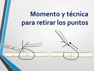 Momento y técnica
para retirar los puntos
 
