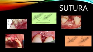 SUTURA
 