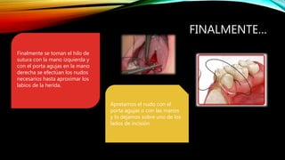 FINALMENTE…
Finalmente se toman el hilo de
sutura con la mano izquierda y
con el porta agujas en la mano
derecha se efectúan los nudos
necesarios hasta aproximar los
labios de la herida.
Apretamos el nudo con el
porta agujas o con las manos
y lo dejamos sobre uno de los
lados de incisión.
 