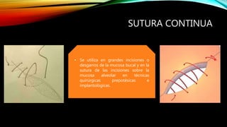 SUTURA CONTINUA
• Se utiliza en grandes incisiones o
desgarros de la mucosa bucal y en la
sutura de las incisiones sobre la
mucosa alveolar en técnicas
quirúrgicas prepotèsicas e
implantològicas.
 
