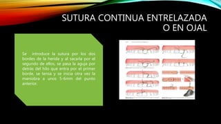 SUTURA CONTINUA ENTRELAZADA
O EN OJAL
Se introduce la sutura por los dos
bordes de la herida y al sacarla por el
segundo de ellos, se pasa la aguja por
detrás del hilo que entra por el primer
borde, se tensa y se inicia otra vez la
maniobra a unos 5-6mm del punto
anterior.
 