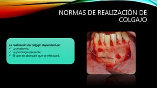 NORMAS DE REALIZACIÓN DE
COLGAJO
La realización del colgajo dependerá de:
 La anatomía.
 La patología presente.
 El tipo de abordaje que se efectuará.
 