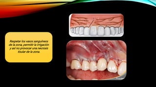 Respetar los vasos sanguíneos
de la zona, permitir la irrigación
y así no provocar una necrosis
tisular de la zona.
 