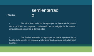 semienterrad
o
• Técnica :
- Se inicia introduciendo la aguja por un borde de la herida
de la porción no colgante, continuando en el colgajo de la misma,
atravesándolo a nivel de la dermis (ida).
-
herida de
(vuelta).
Se finaliza sacando la aguja por el borde opuesto de la
la porción no colgante y lateralmente al punto de entrada inicial
 