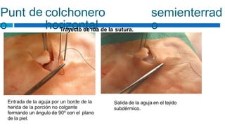 Punt
o
de colchonero
horizontal
semienterrad
o
Trayecto de ida de la sutura.
Entrada de la aguja por un borde de la
herida de la porción no colgante
formando un ángulo de 90º con el plano
de la piel.
Salida de la aguja en el tejido
subdérmico.
 