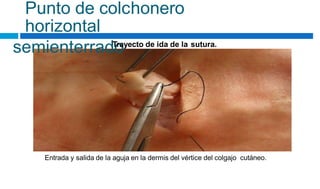 Punto de colchonero
horizontal
semienterrado
Trayecto de ida de la sutura.
Entrada y salida de la aguja en la dermis del vértice del colgajo cutáneo.
 