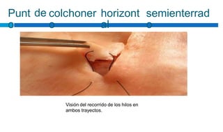 Punt
o
de colchoner
o
horizont
al
semienterrad
o
Visión del recorrido de los hilos en
ambos trayectos.
 