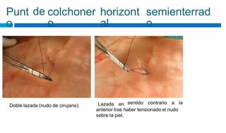Punt
o
de colchoner
o
horizont
al
semienterrad
o
sentido contrario a la
Lazada en
Doble lazada (nudo de cirujano).
anterior tras haber tensionado el nudo
sobre la piel.
 