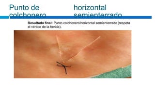 Punto de
colchonero
horizontal
semienterrado
Resultado final: Punto colchonero horizontal semienterrado (respeta
el vértice de la herida).
 