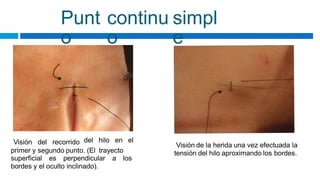 Punt
o
continu
o
simpl
e
del hilo en el
Visión del recorrido Visión de la herida una vez efectuada la
tensión del hilo aproximando los bordes.
primer y segundo punto. (El trayecto
superficial es perpendicular a los
bordes y el oculto inclinado).
 