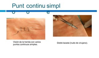 Punt
o
continu
o
simpl
e
Visión de la herida con varios
puntos continuos simples.
Doble lazada (nudo de cirujano).
 
