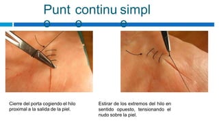 Punt
o
continu
o
simpl
e
Cierre del porta cogiendo el hilo
proximal a la salida de la piel.
Estirar de los extremos del hilo en
sentido opuesto, tensionando el
nudo sobre la piel.
 