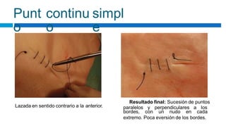 Punt
o
continu
o
simpl
e
Resultado final: Sucesión de puntos
paralelos y perpendiculares a los
Lazada en sentido contrario a la anterior.
bordes, con un nudo en cada
extremo. Poca eversión de los bordes.
 